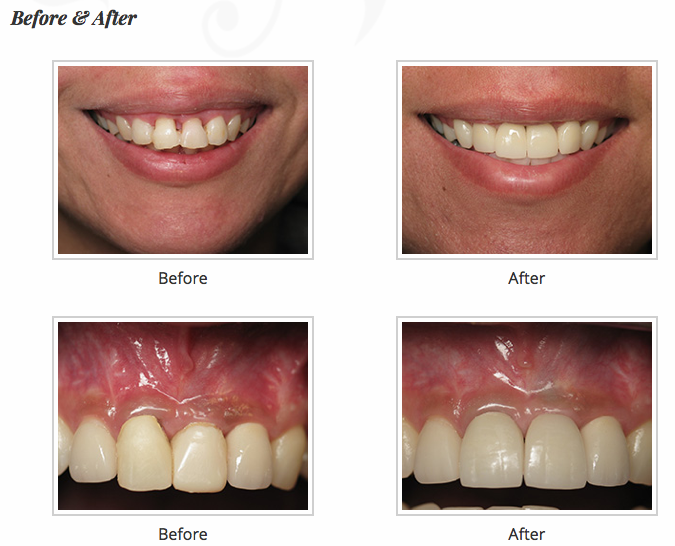 Before and after images of dental implant.