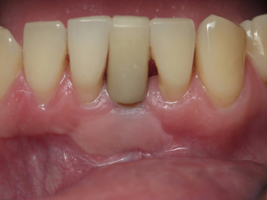 Implant on front teeth
