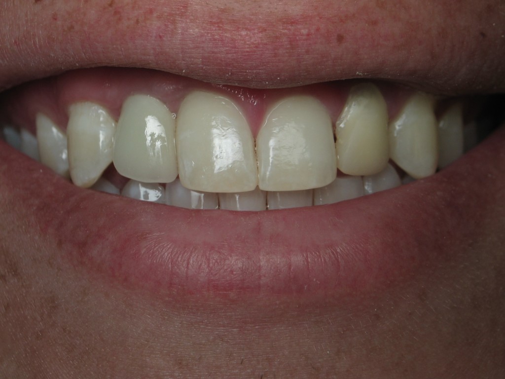 Dental Implant case 2016